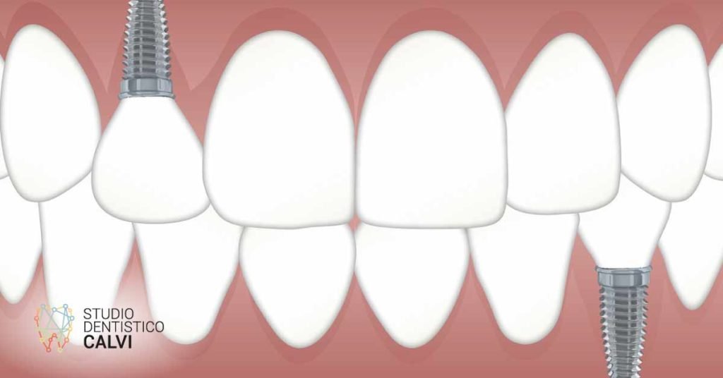 Perimplantite | Studio Dentistico Calvi