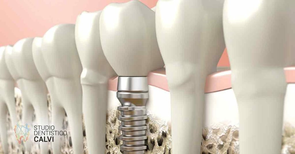 Perimplantite | Studio Dentistico Calvi