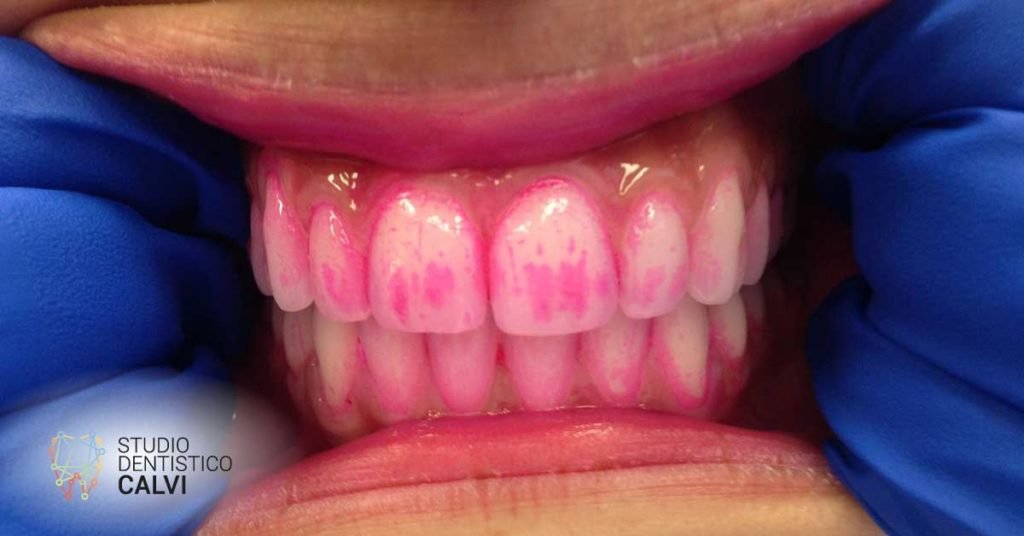 Rivelatore di placca | Studio Dentistico Calvi