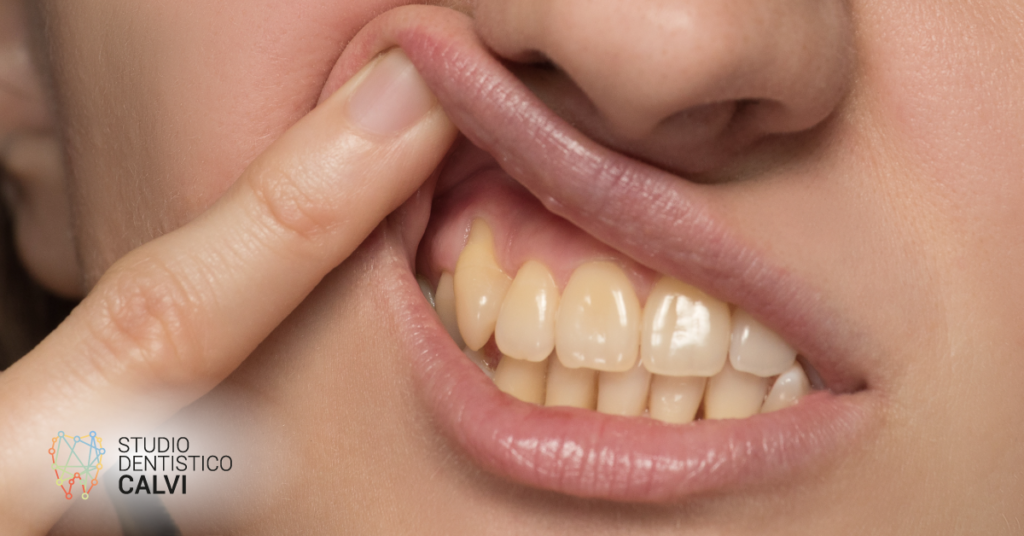 Gengive nere | Studio Dentistico Calvi