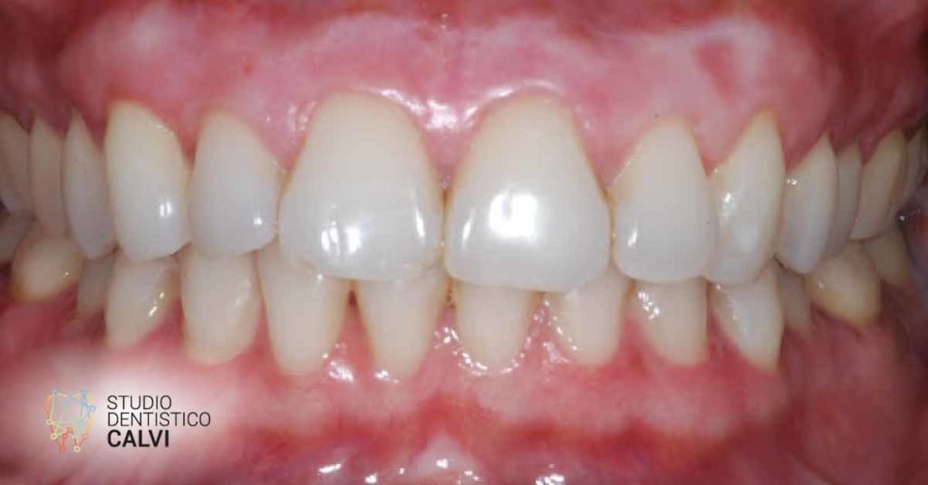 Gengive bianche | Studio Dentistico Calvi