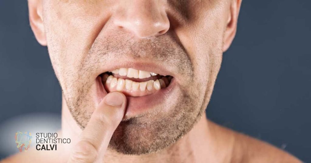 Gengivostomatite | Studio Dentistico Calvi