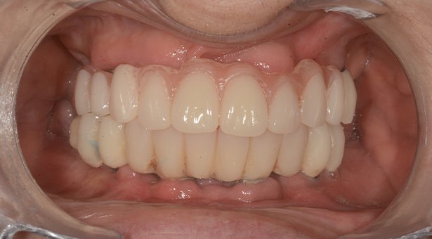 Studio Dentistico Calvi _ Implantologia 2