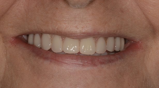 Studio Dentistico Calvi _ Implantologia 3